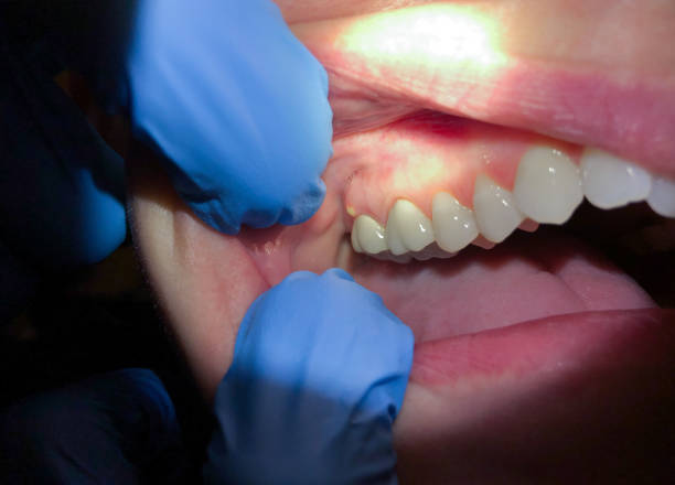 Best Emergency Tooth Extraction in Rural Hall, NC